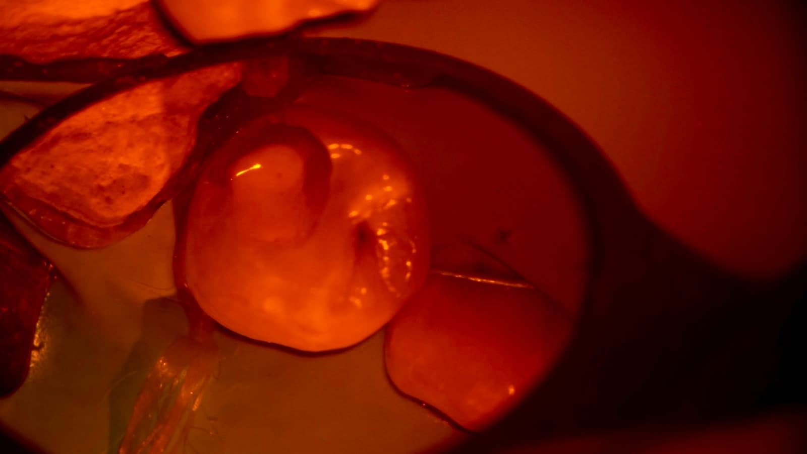 Vista con microscopio de la apertura de un molar durante un retratamiento